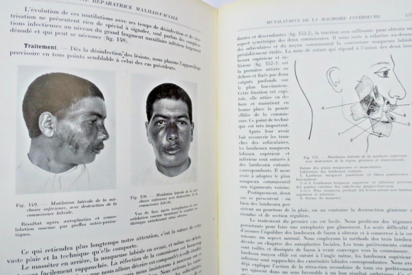 Chirurgie réparatrice maxillo-faciale. Autoplasties - Prothèse - 1940 – Image 5