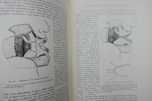 Chirurgie réparatrice maxillo-faciale. Autoplasties - Prothèse - 1940 – Image 8