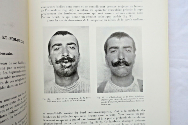 Chirurgie réparatrice maxillo-faciale. Autoplasties - Prothèse - 1940 – Image 9