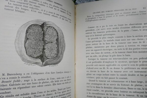 chirurgie  MEMOIRES SUR LA GALVANOCAUSTIQUE THERMIQUE 1876 – Image 4