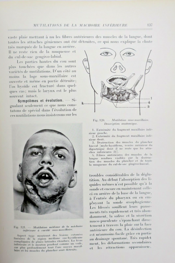 Chirurgie réparatrice maxillo-faciale. Autoplasties - Prothèse - 1940 – Image 6