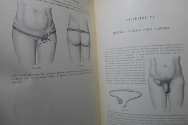 Bandage Herniaire. Autrefois Aujourd'hui 1899 – Image 3